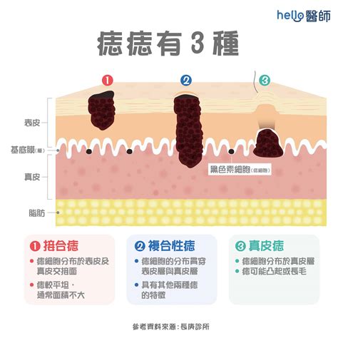 痣多的原因|痣變大、痣多或長毛會變皮膚癌？認識痣的形成與原因